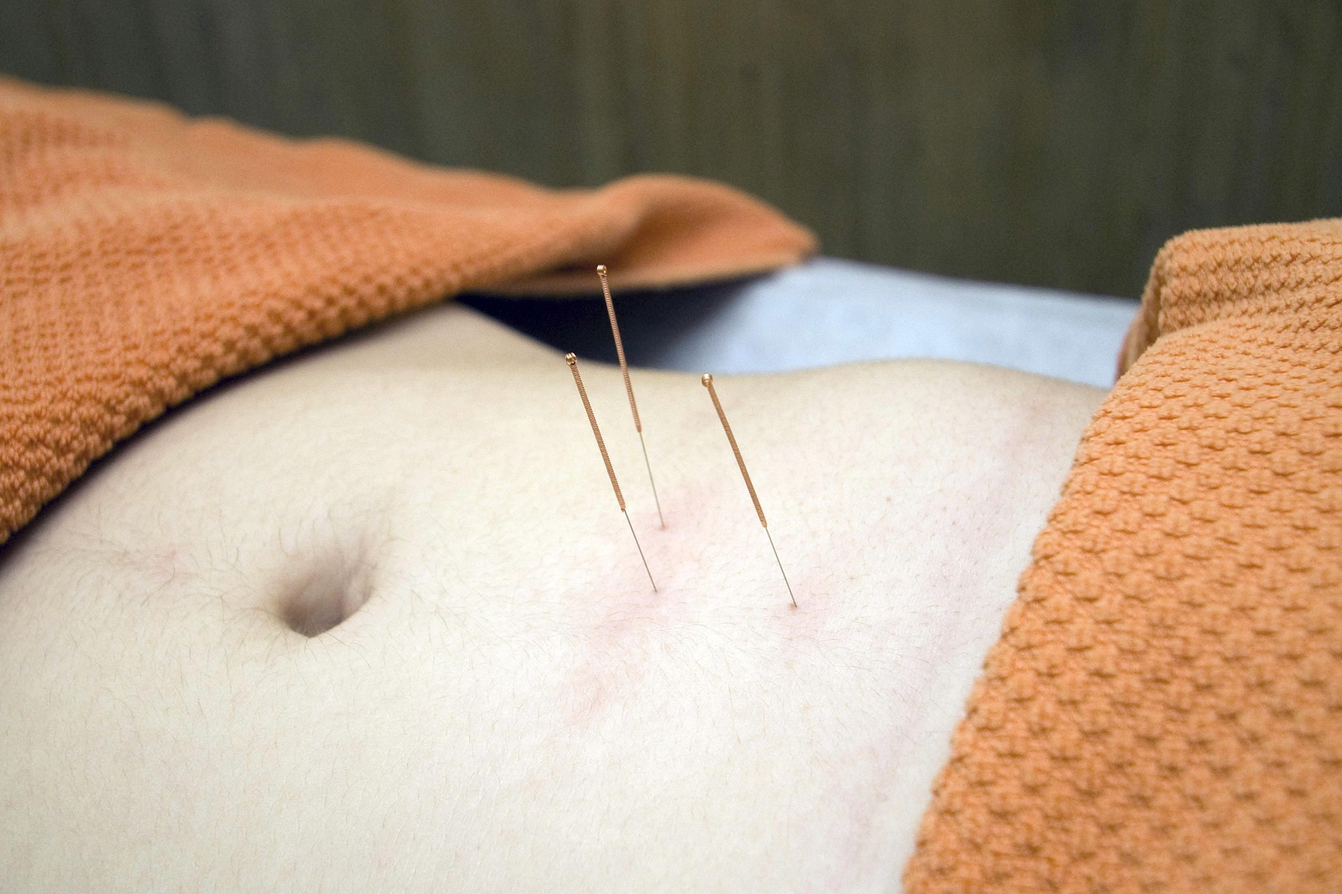 Waarom dry needling steeds populairder wordt in de fysiotherapie